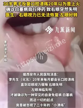 36岁男子口腔溃疡20年